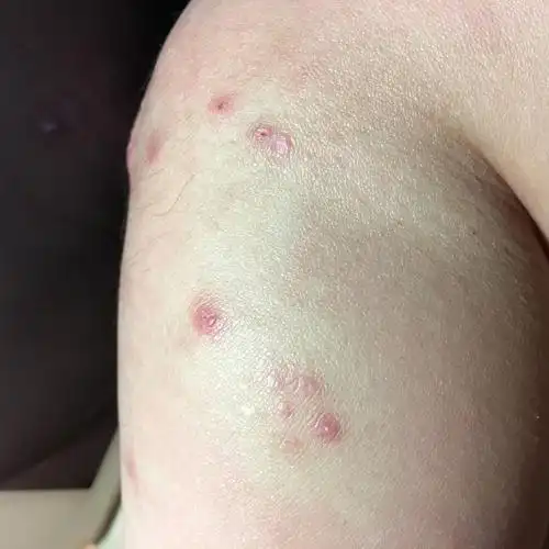 请问这是虫咬皮炎,丘疹荨麻疹,还是丘疹湿疹.