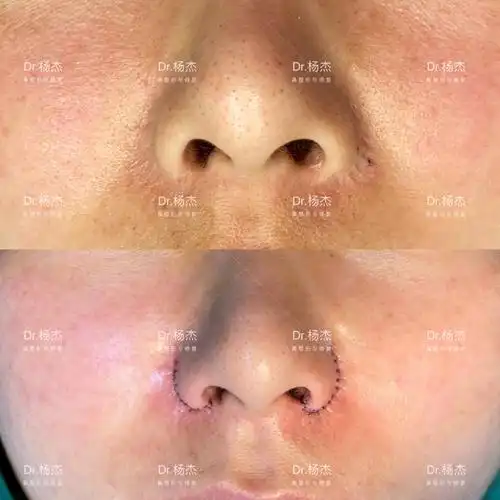 鼻翼缩小疤痕修复