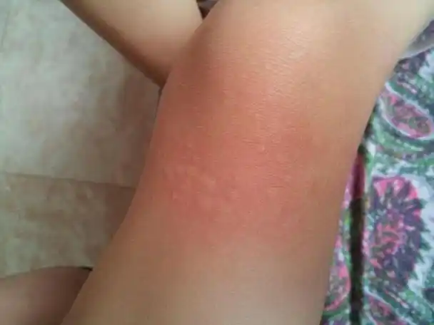 小孩身上老是过敏怎么办小孩身上总是过敏怎么办