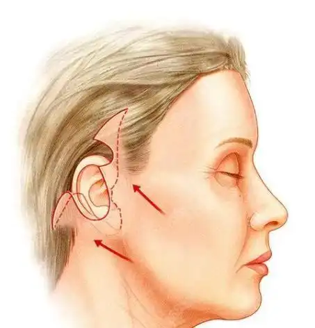 上海艺星面部提升怎样艺星陈成小切口拉皮提升好价格合理