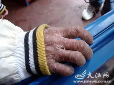 兄弟俩全身长"鱼鳞" 双手比八十岁老人还苍老(组图)