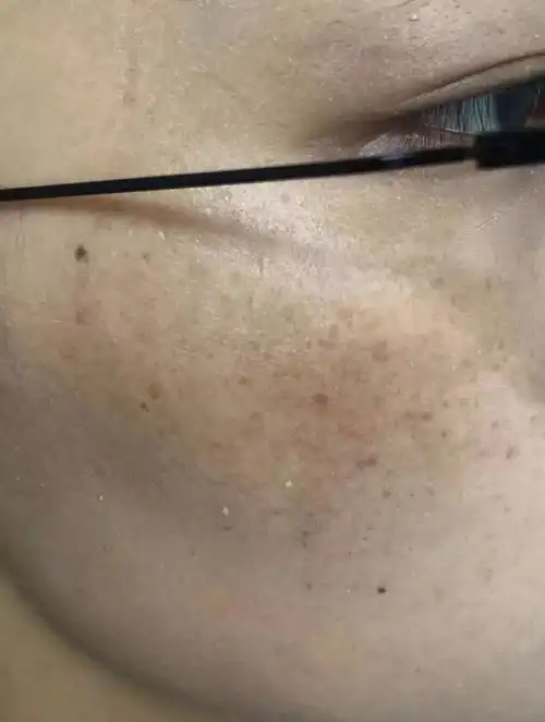 当皮肤科医生发现自己长斑之后