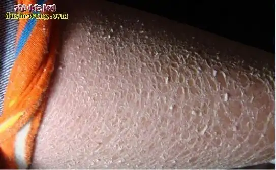 改善皮肤干燥的方法:1,冬天身体水分流失较快,因此一定要注重水分的