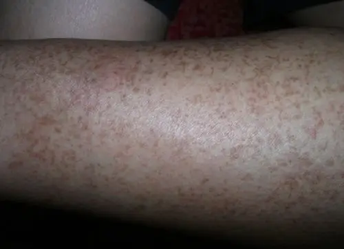 腿上一直有这样褐色的斑点,很多年了,今天碰到一个中医,说这是糖尿病