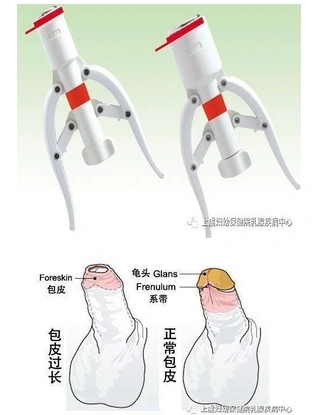 吻合器包皮环切术_包皮过长_手术_治疗方式 - 好大夫在线