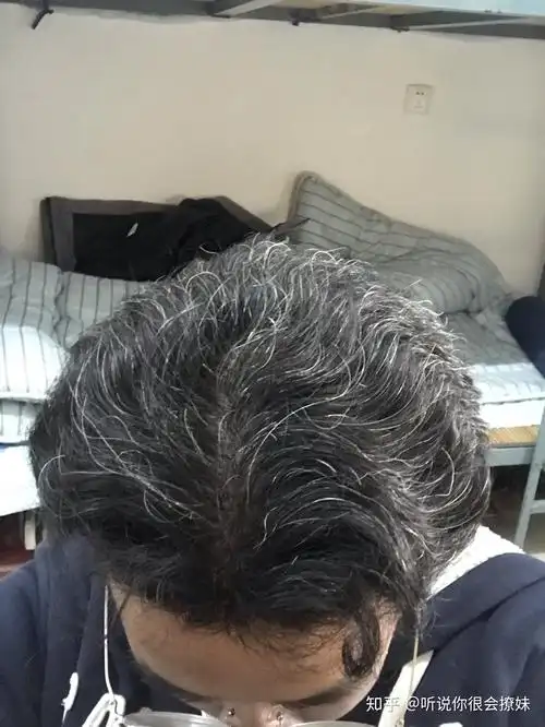 女生少白头严重白头发一大半很烦恼自卑平时染发告诉