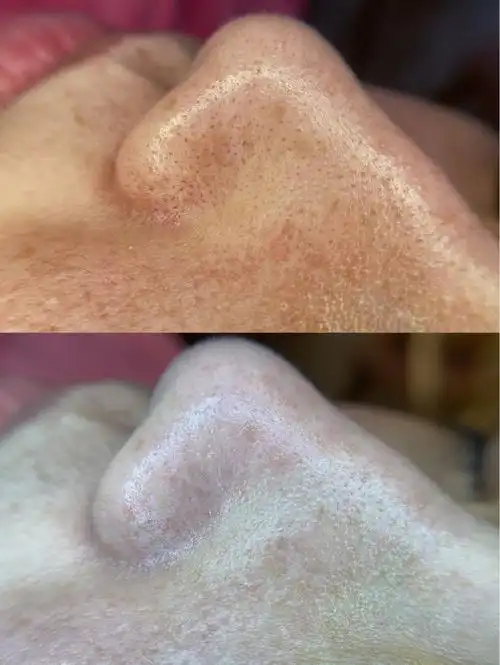 毛囊清洁术除了深层清洁之外,还有以下几大功效: 第一:市面上唯一一款