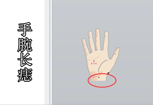 手腕长痣