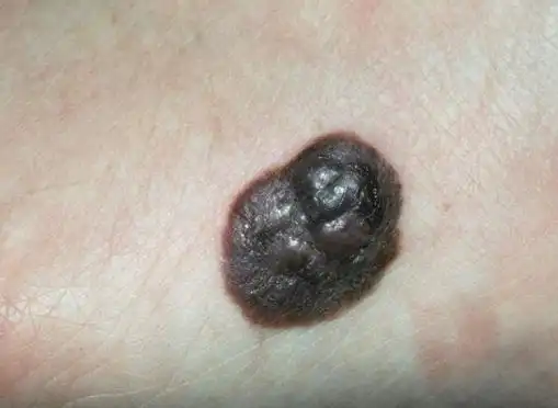 1 症状一在黑色素瘤最初的阶段,患者的正常皮肤上多会出现黑色素沉着