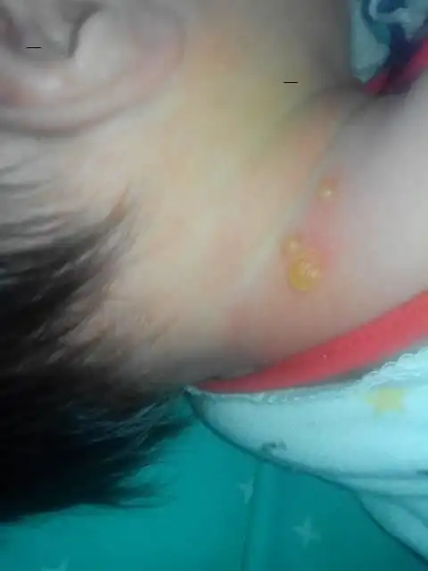 问:请问,男孩,刚出生7天,脖子上起了三个水泡,是什么原因