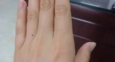 女生左手无名指突然长痣女生左手无名指突然长痣代表什么
