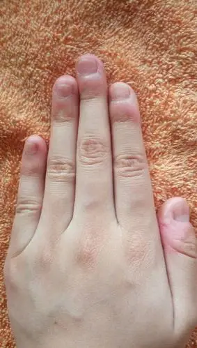 我喜欢啃指甲,从小就啃,啃了十多年了,现在再留,还留的好吗?