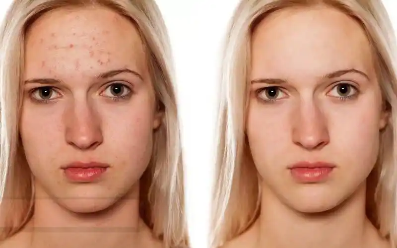 如何用ps快速磨皮祛痘?