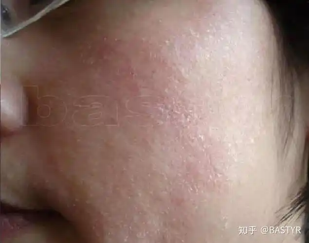 说说皮肤结构知识之(皮脂膜)