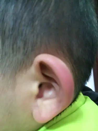 孩子耳朵起来肿的很大 怎么回事 在线坐等回答