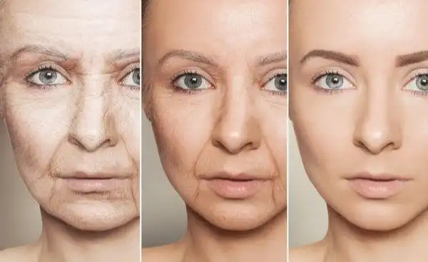 蔡时玖脸部皮肤松弛下垂知道这几点轻松解决