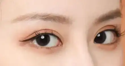 间距过短的人不适合做双眼皮手术(可根据「三庭五眼」标准粗略判断,但