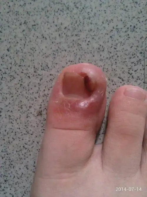 甲沟炎看什么医生