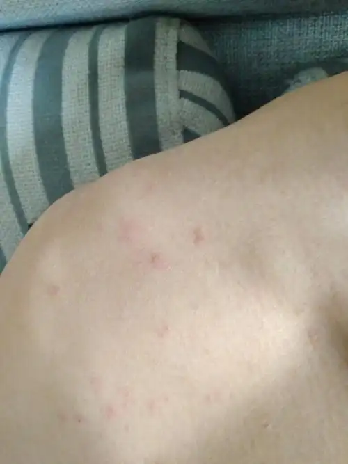 痤疮,脂溢性皮炎,毛囊炎怎么看出区别呢?三种皮肤病各怎么治?