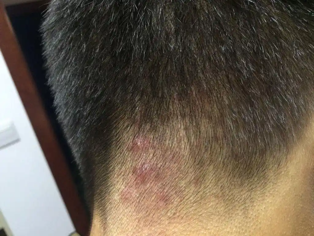 头皮上有小豆豆,可能是头皮毛囊炎,千万要当心,否则后悔莫及