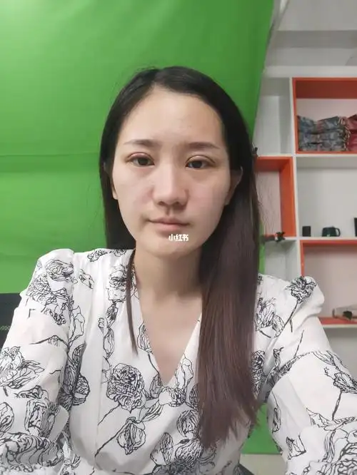 埋线双眼皮  #埋线双眼皮恢复