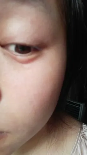 为什么眼睛下面会长这种类似蚊子咬的小包,是什么过敏?
