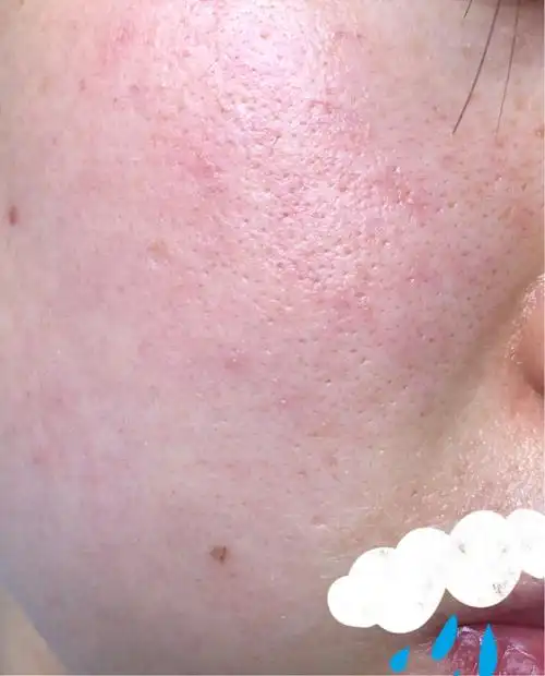 如何增加面部皮肤的角质层?