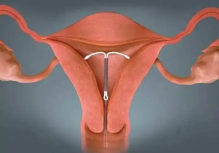 避孕环是一种常见的避孕方法,通过手术放置在女性子宫内,防止卵子排出