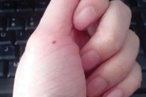 左手大拇指长痣是什么意思 左手大拇指长痣图解大全