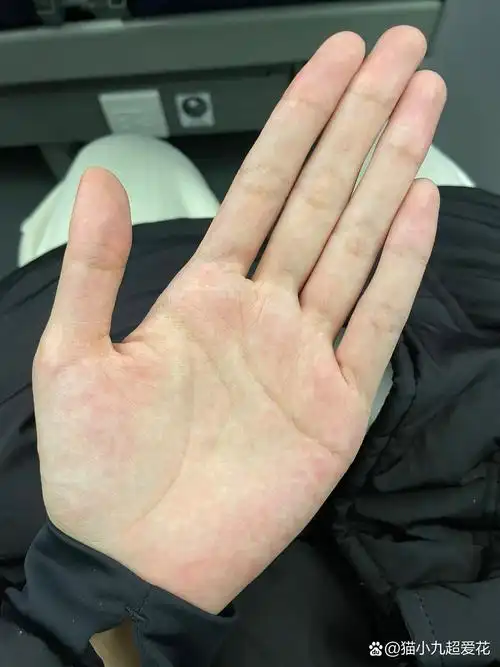 出差路上刷到马凡综合征整个人都不好了01 从小手就大,细长,脚是37