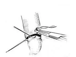 医学图解:包皮手术全过程大揭秘