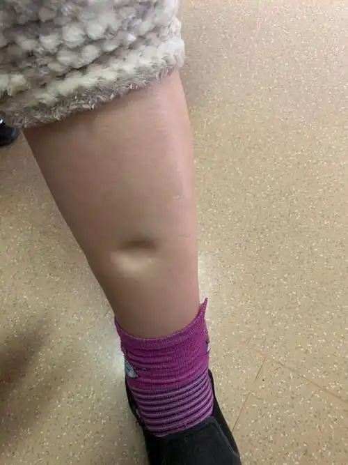 肾病综合征,怎么治疗大量蛋白尿?_医学界-助力医生临床决策和职业成长