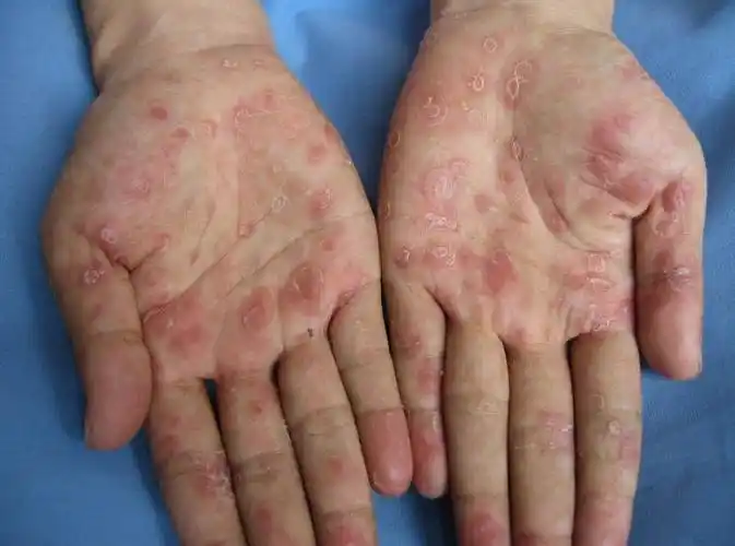 [回答] 梅毒的获得主要是感染了梅毒螺旋体,这种螺旋体又叫做苍白色