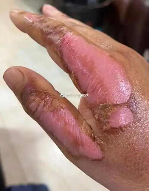 何新:美宝烧伤膏发生的皮肤再生奇迹|疤痕|烫伤|死皮|徐荣祥_网易订阅