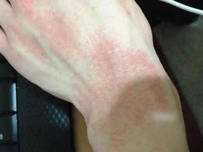 一开始两只手手背碰到热水很痒,到后来就是碰到冷风有点疼!