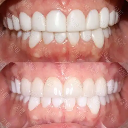 树脂贴面与瓷贴面效果对比