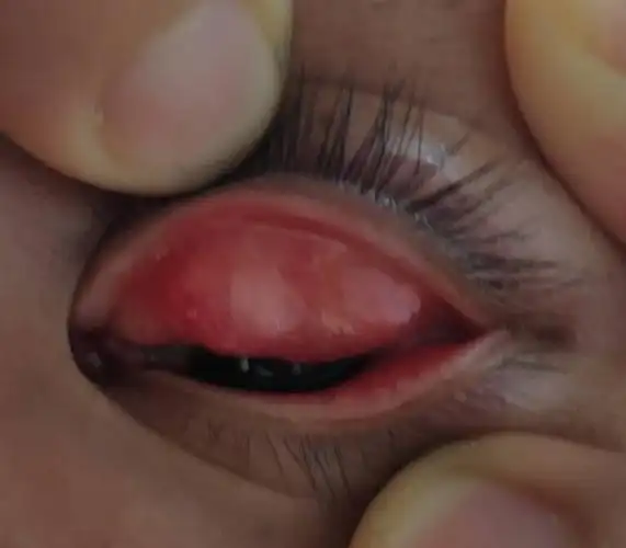 上眼皮里面长个小白泡,痒痒并且磨眼镜