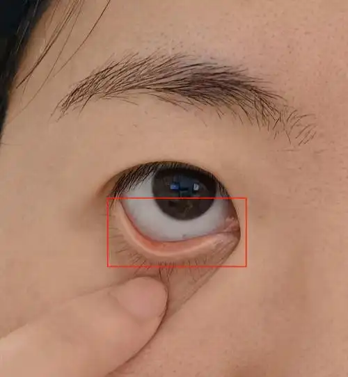 面部皮肤和嘴唇的颜色可能受先天因素或化妆品掩盖,但眼睑的颜色不会