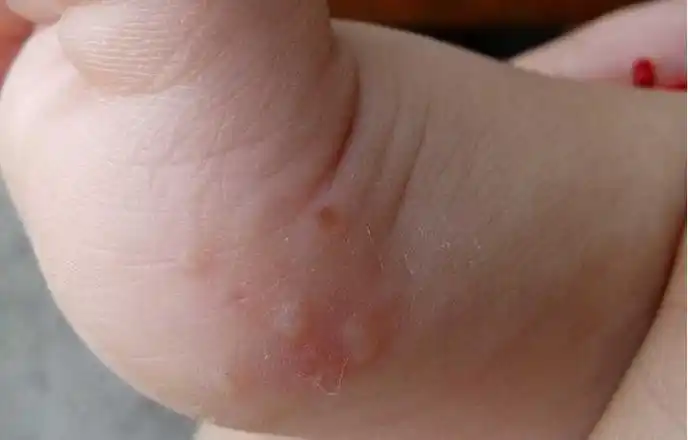5孩子脚上长水泡怎么办:宝妈的经验分享