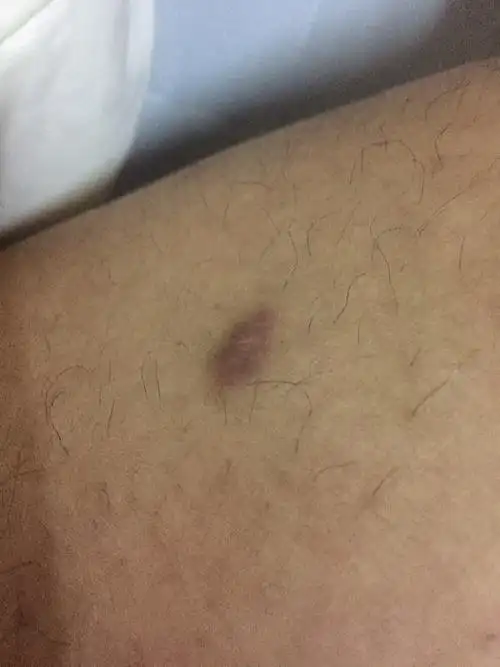 大腿上长了一个肉疙瘩,很多年了,不疼偶尔会痒,是什么呢?