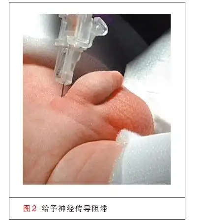 新生儿包皮环切术综述