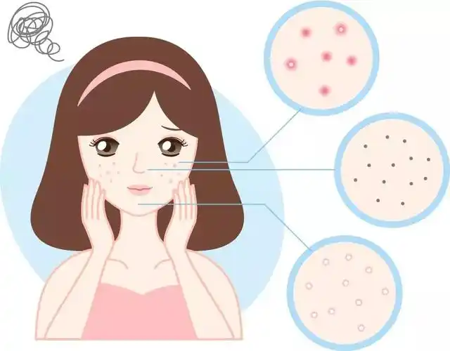 欧瑞莲化妆品美容贴士 | 毛孔大,黑头密,痘痘多,原来是你清洁没做好?