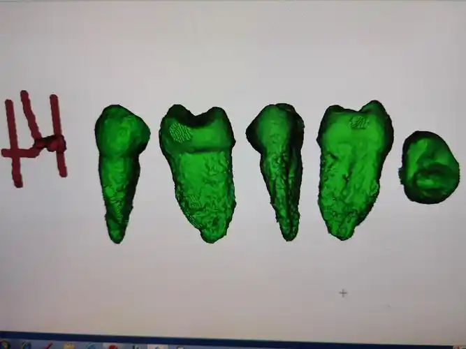 右侧上颌第一前磨牙解剖形态