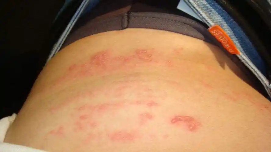 在昆明皮肤瘙痒怎么办