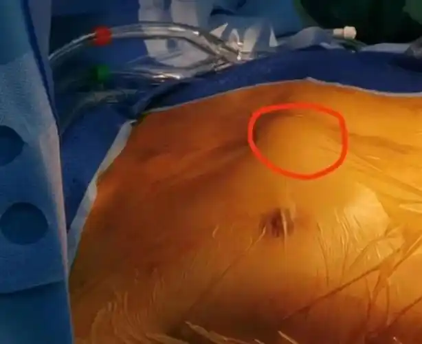 这是我们手术切口的必经之路,很难完全避免在开胸过程中锯破瘤体,造成