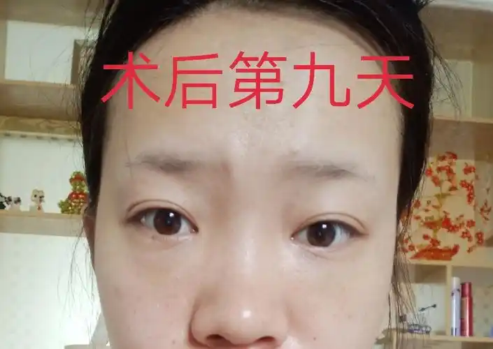 术后第一天至第12天自体脂肪填充泪沟术后恢复效果分享