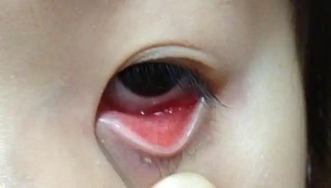 6岁小孩子 眼睛里边上下眼皮翻起 很红 特别是傍晚到晚上眼屎特别多