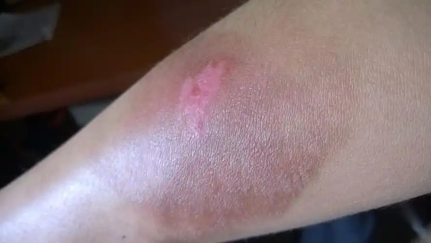 开水烫伤,我最担心的是留疤.