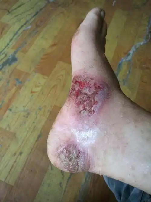 因脚上多年皮肤病一直没看好,前不久用其它产品感染发炎皮肤严重溃烂