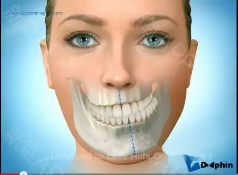 先贴一张不正常的咬合图片